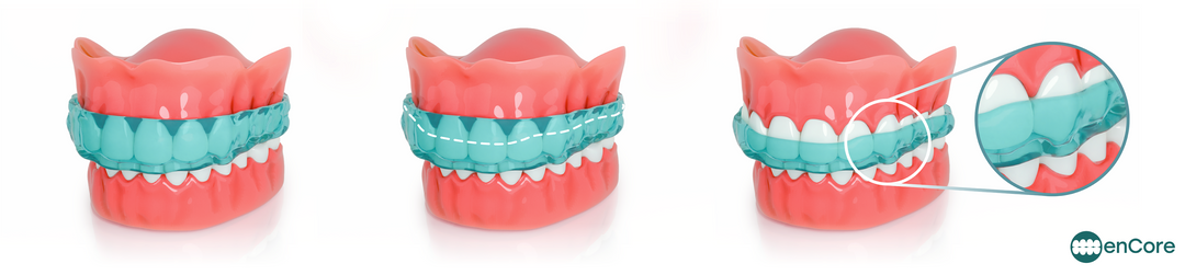 enCore dental night guards for teeth grinding and clenching aka bruxism